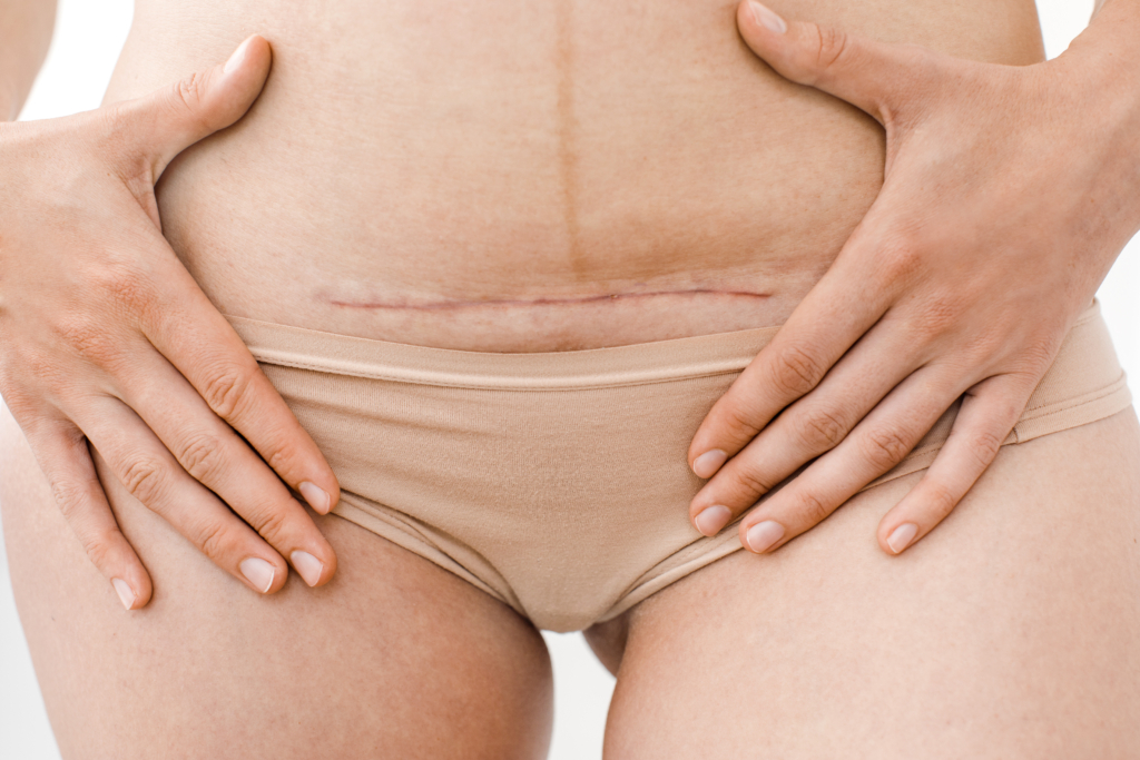 Nahaufnahme einer Narbe am Bauch einer Frau die nicht gut verheilt ist