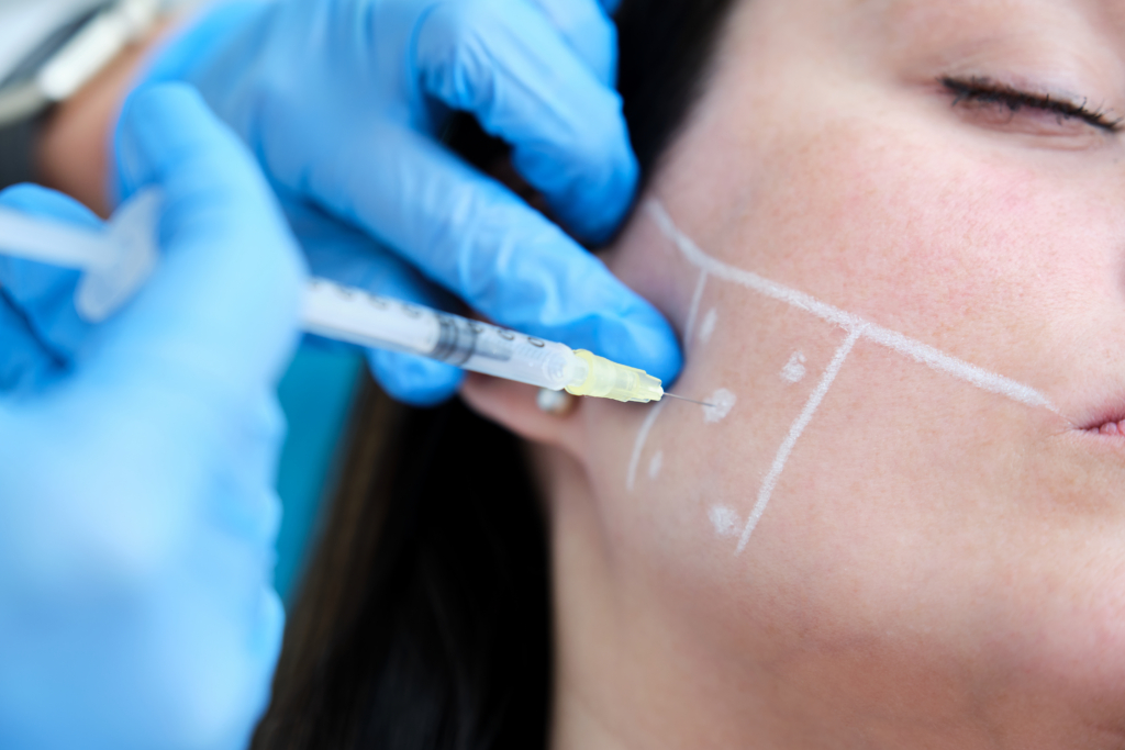 Wange einer Frau die mit drei Strichen und fünf Punkten markiert ist. Zwei Hände mit blauen Hygienehandschuhen halten die Wange und führen eine Spritze in die Wange ein